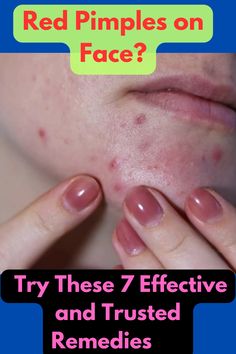 Say goodbye to red pimples with these 7 proven treatments. Learn the best ways to reduce redness, soothe your skin, and keep breakouts under control.
#PimpleTreatment
#RedPimples
#ClearSkin
#AcneSolutions
#SkinCareTips
#BeautyHacks
#HealthySkin
#AcneHelp
#SkinCareRoutine
#AcneRelief
#NaturalRemedies
#DIYSkincare
#AcnePrevention
#SelfCare
#SkinHealth Redness Pimple, Pimples On Face, Skin Discoloration, Homemade Skin Care