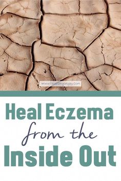 Is your skin your biggest nemesis? It is itching, burning, flaking and just plain irritating? Learn how to Heal Your Eczema from the Inside Out right here! Contact Dermitis Hands, Excema Relief, Holistic Remedies, Healing Food, Holistic Nutrition, Cartoon Girl, Natural Treatments, Skin Problems