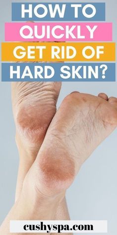 Homemade Foot Cream, Cracked Heel Remedies, Dry Heels, Uses For Vicks, Thick Skin, Cracked Heels