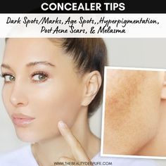 Learn essential makeup tips for selecting the best concealer for your dark spots, acne scars, age spots, and melasma. #concealertips #makeuptips Concealer Tips, The Best Concealer, Age Spots On Face, Essential Makeup