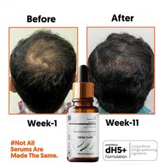 Hair Growth Serum Hair Growth Serum Designed for Thinning Hair & Hair Loss 50ml PROVEN INGREDIENTS IN ONE SERUM: A super potent, multi-functional hair growth serum with award winning ingredients Redensyl 3% + Anagain 4% + Baicapil 3%. Starts to show reduction in hairfall & visible results in 3 months. SAFE & EFFECTIVE HAIR SERUM: Mount Beauty A completely safe, yet powerful serum for men & Women, that can be used everyday without any side-effects. IMPROVED HAIR STRNGTH: The presence of potent ingredients contributes to stronger and more resilient hair, reducing the likelihood of breakage, hair straightening & dry frizzy hair. NOURISHED HAIR FOLLICLES: The combination of these ingredients ensures that the hair follicles receive essential nutrients, promoting overall hair health and vitality Breakage Hair, Serum Hair, Dry Frizzy Hair, Hair Growth Serum, Oily Scalp, Rosemary Oil, Growth Serum, Thinning Hair, Hair Regrowth