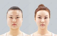 Facial Profile, Square Jaw, Facial Aesthetics, Nose Job, Lifestyle Changes