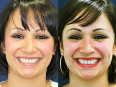 Dimple Implants Before and After Dimple Piercings, Celebrity Teeth, Reverse Wrinkles, Homemade Organic Skin Care, Facelift Without Surgery, Face Lift Exercises, Dimple Piercing, Facial Yoga, Face Exercises