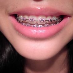 Dental Braces Colors, Lingual Braces, Braces Bands, Kids Braces