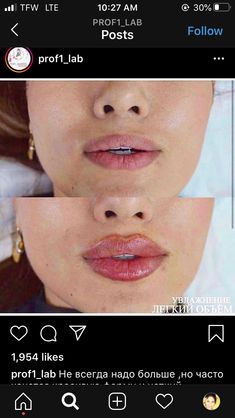 Lip Fillers Before And After 1ml Russian, Russian Lips Filler Before And After, Lip Flip Before And After, Lip Injections Before And After, Lip Flip Botox Before And After, Lip Fillers Before And After 1ml, Bad Lip Injections