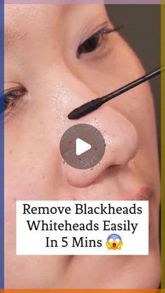 How To Get Rid Of Blackheads On Nose At Home, How To Get Rid Of Black Spots On Face, How To Get Rid Of Blackheads, Removing Blackheads From Nose Videos, How To Remove Whiteheads, Diy Blackheads Removal, Neck Pimples, Best Peel Off Mask, Remove Blackheads From Nose