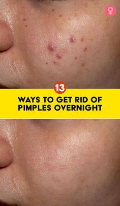 Pimples can make you feel less confident and take a toll on you mentally. But why worry when you can get rid of pimples with simple remedies. Check them out now! Zit Remedy, Get Rid Of Pimples Overnight, Rid Of Pimples Overnight, Redness Pimple, Small Pimples, How To Clear Pimples