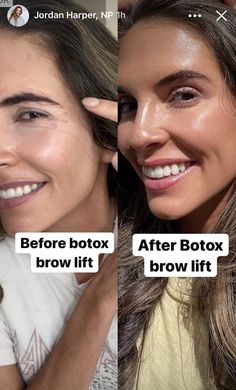 Eyebrow Botox Lift, Botox Eye Lift, Botox Eyebrow Lift, Botox For Hooded Eyelids, Botox Brow Lift, Under Eye Fillers, Beauty Procedures