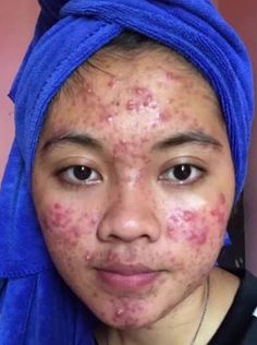 Skin Positivity, Women Skin, Self Conscious, Skin Problems, Blackheads, Skin Care, Skin, Photographer