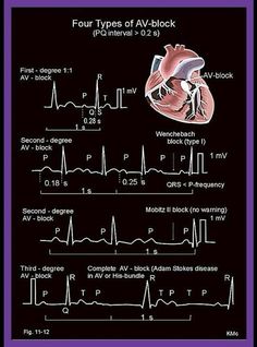 There are three basic types of AV nodal block: First-degree AV block. Second-degree AV block. Type I second-degree AV block (Mobitz I), also known as Wenckebach block. Type 2 second-degree AV block (Mobitz II) – due to a block in or below the bundle of His. Third-degree AV block (complete heart block) First-degree atrioventricular block … Continue reading ECG Heart Block Rhythms – Four types of atrio-ventricular (AV)-block Medsurg Nurse, Medsurg Nursing, Cardiology Nursing, Paramedic School, Med Surg Nursing, Nursing Mnemonics, Medical Student Study, Cardiac Nursing, Nursing School Survival