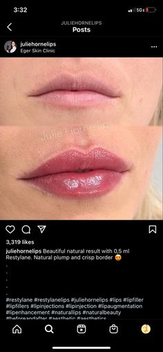 Very Natural Lip Filler, Heart Shape Lips Fillers, Lip Filler Shape Ideas Natural, Lip Filler Inspiration Natural, Lip Filler Inspo Pics, Lip Filler Shape Ideas 1ml, 1ml Lip Filler Before And After, Heart Shaped Lip Filler, Hip Filler