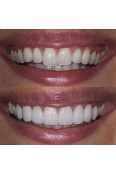 Veneers Teeth Styles, Composite Bonding Teeth, Perfect Teeth Smile, Celebrity Teeth, Teeth Correction, Dental Photos