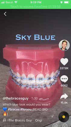 Baby Blue Braces, Power Chain Braces, Braces Transformation, Dental Braces Colors, Braces Colors Combinations, Blue Braces, Tongue Web Piercing