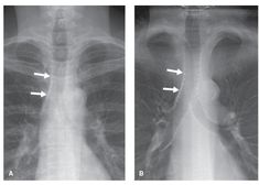 an x - ray shows the chest and ribs with arrows pointing to different areas in it