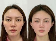 #plasticsurgery #plasticsurgerygonewrong #beforeafter #celebritiesbeforeafter #hollywoodstars #bignosesurgery #surgery #facesurgery #vlinesurgery #koreanplasticsurgery #kpopplasticsurgery #nosejob #jawreductionsurgery #eyesurgery #cheekfillers #rhinoplasty #facelift #plasticsurgeryfails #expensiveplasticsurgery #viral Kpop Plastic Surgery, Jaw Reduction Surgery, V Line Surgery, Plastic Surgery Fail, Korean Plastic Surgery, Nose Jobs, Rhinoplasty Nose Jobs, Face Surgery