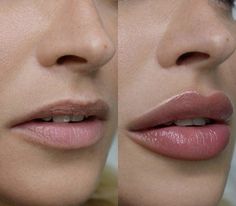 #aesthetics #medicine #plasticsurgery #lips #lipfillersbeforeandafter #botoxinjections #injection #lipfiller #filler #nursery #doctor #esthetician Lips Aesthetic, Lip Permanent Makeup, Lip Filler