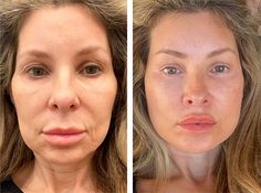 best mini facelift before after photos Endoscopic Brow Lift Before And After, Skin Resurfacing Before And After, Lower Face Lift Before And After, Mini Face Lift Before And After, Deep Plane Facelift, Facelift Surgery