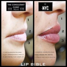 Downturned Lips Filler, Lip Filler Downturned Lips, 1 Ml Lip Filler Before And After, 0.5 Ml Lip Filler Before And After, Natural Lip Fillers, Nose Surgery Rhinoplasty