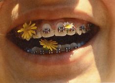 a woman's smile with flowers on it and braces attached to the teeth