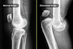 Your knees have lots of parts, and you use them a lot, so there Knee Dislocation Exercises, Xray Pictures, Dislocated Knee, Knee Dislocation, Knee Pain Stretches, Medical Radiography, Knee Pain Remedy, Fit Moms, Swollen Knee