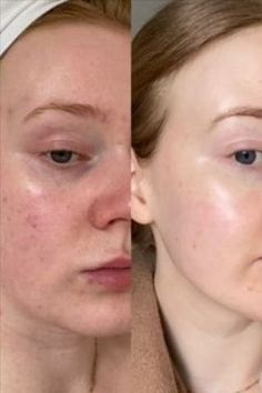 The Results Of AHA Skin Peels Remove Skin Tags Naturally, Brown Spots Removal, Mandelic Acid, Dark Under Eye, Skin Blemishes, Peeling Skin, Undereye Circles, Low Self Esteem, Uneven Skin Tone