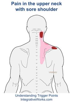 Shoulder Trigger Points, Trigger Points Neck, Shoulder Muscle Pain, Sore Shoulder, Sore Neck, Forward Head Posture, Back Pain Remedies, Upper Back Pain