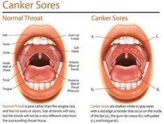 Canker Sore On Tongue, Throat Ulcers, Canker Sore Causes, Blister Remedies, Canker Sore Relief, Mouth Blisters, Canker Sore Remedy, Tongue Sores, Fever Blister