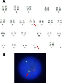 What is Chronic Myelogenous Leukemia? - Pathosomes Red Blood Cells, Stem Cells