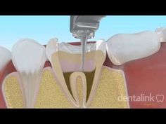 Endodoncia - EXPLICACIÓN A PACIENTES- Dentalink Software Dental - YouTube Dental Fillings, Dental Office, Software