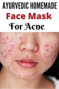 There are many Homemade face masks for acne , , and anti-aging food which help in removing the stubborn acne. #acne #homemade #mask #DIY Instant Acne Removal Face Masks, Homemade Remedy For Acne, Face Mask For Acne Prone Skin, Anti Acne Face Mask, Acne Face Mask Homemade, Face Care Acne