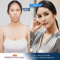 Korean Surgery, Gangnam Seoul, Face Surgery