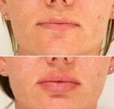 Lip Filler Side Profile, Lip Filler Before And After 1ml, Lip Fillers Shapes, Lip Fillers Juvederm, Russian Lips, Lips Fillers, Lips Shape