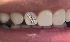 a close up of a person's teeth with braces and stars on them