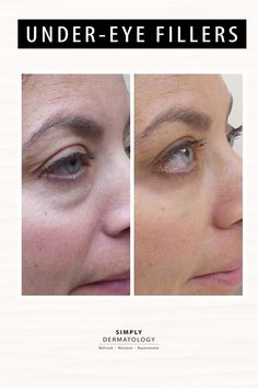 Undereye Bags, Under Eye Fillers, Tear Trough, Under Eyes, Under Eye Bags, Tired Eyes, Dermatology, Beauty Health, Anti Aging