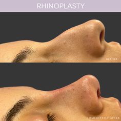 Rhinoplasty Before and After Rhinoplasty Droopy Tip, Nose Rhinoplasty Before After, Closed Rhinoplasty Before And After, Button Nose Nose Job, Nose Plastic Surgery Before After, Before And After Plastic Surgeries, Nose Before And After, Dorsal Hump Rhinoplasty