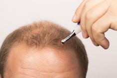 A1Services Ph. 9873310062 - Get Advanced Affordable Top 5 Hair Transplant Cilinic Near Me Delhi that works with the best clinic in Delhi. Painless & Quick Procedure with successful sessions. Affordable Top 5 Hair Transplant Cilinic Near Me Delhi is done to add more hair to an area on your head that may be thinning or balding. Affordable Top 5 Hair Transplant Cilinic Near Me Delhi Offers. Affordable Top 5 Hair Transplant Cilinic Near Me Delhi. Regrow Hair Naturally, Prp Hair, Hair Transplant Results, Hair Doctor, Increase Hair Growth, Regrow Hair, New Hair Growth