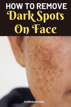 Looking for what causes and best treatment dark spots on face at home? Check out how to get rid of dark spots on face overnight remedies. Overnight Remedies, Brown Spots On Skin, Spots On Skin, Natural Face Skin Care, Spot Remover, Dark Spots On Skin