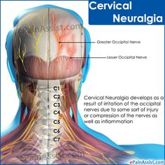 Occipital Neuralgia, Cervical Pain, Craniosacral Therapy, Neck Injury, Head Pain, Human Body Anatomy, Chronic Migraines, Medical Anatomy, Tension Headache