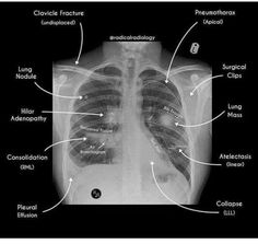 an x - ray shows the chest and ribs with labels in spanish, english and latin