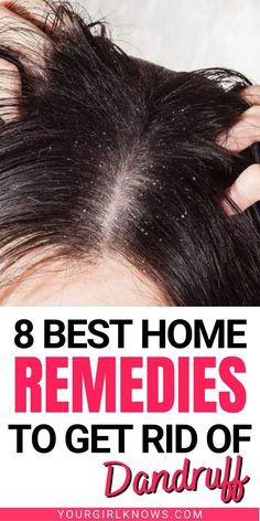 How To Get Rid Dandruff, How To Get Rid Off Dandruff, Best Way To Get Rid Of Dandruff, Natural Way To Get Rid Of Dandruff, How To Get Rid Of Greasy Hair And Dandruff, How To Get Rid Of Bad Dandruff, Remedies For Dandruff How To Get Rid, Homemade Remedies For Dandruff, Hair Mask To Get Rid Of Dandruff