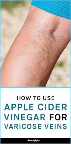 how to use apple cider vinegar for varicose veins Varicose Veins Essential Oils, Apple Cider Vinegar Remedies, Yeast Infection Causes, Varicose Vein Remedy, Health Trends, Health Ideas, Natural Health Remedies, Cider Vinegar, Apple Cider Vinegar