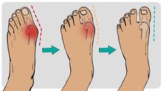 Hammertoe Remedies, Foot Pain Relief Remedies, Toe Exercises, Toe Straightener, Pain Relief Remedies, Home Health Remedies