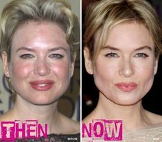 Renee Zellweger before and after  #after #before #renee #zellweger Plastic Surgery Photos, Hair Implants, Renee Zellweger, Cream Makeup, Cameron Diaz, Celebrity Makeup