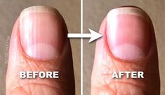 Your fingernails and toenails say a lot about your health! But what do those vertical lines mean, and should you be worried? Soft Feet Remedy, Nail Ridges, Lines On Nails, Foot Soak, Clear Nail Polish, Callus Removal, Vertical Lines, Homemade Face, Homemade Face Masks