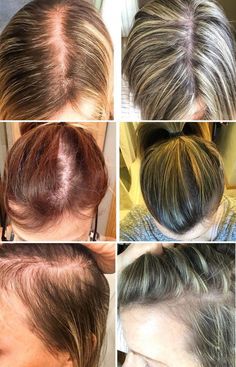 Postpartum Hair, Natural Hair Growth Remedies, Loss Hair, Female Hair, After Pregnancy, Natural Hair Growth, Acupressure, Postpartum