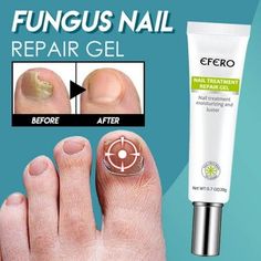 Wuvpotd Nail Treatment Feet Care Gel Whitening Toe Nail Fungus Removal Repair Essence Description Searching for the best home remedy for toenail fungus? Dotorus is your way. Dotorus is a gel designed to kill fungus, improve the appearance of nails damaged by fungus and prevent fungus re-infection with a gel coating. Clinically proven to reduce discoloration, correct deformed shape, clean out yellowing or dark keratin debris, normalize thickness and hydratebrittle nails Containing ingredients suc Nail Feet, Cracked Nails, Nail Infection, Gel Toes, Fungal Nail, Skin Care Lotions, Nail Repair, Damaged Nails, Nails White