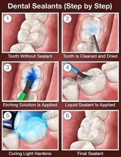 Dental sealants are a clear and protective coating that is applied to the biting surfaces of the back teeth. The sealant protects the tooth from getting a cavity by shielding against bacteria and plaque. Sealants are most commonly placed on children's permanent back teeth because they are more prone to cavities.  Dentaltown - Patient Education Ideas Dental Sealants, Dental Hygiene Student, Dental Spa, Kedokteran Gigi