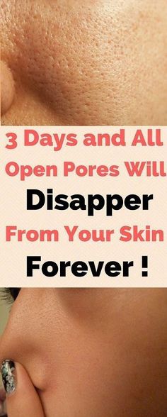 Greasy Skin, Open Pores, Skin Care Wrinkles, Natural Aging, Top Skin Care Products, Large Pores, Skin Pores, Skin Remedies, Skin Care Cream