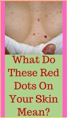 What Do These Red Dots On Your Skin Mean? - MoRtG What Is Health, Womens Health Care, Health Signs, Tongue Health, Women Health Care, Health Tips For Women, Natural Health Tips, Good Health Tips, Health Check