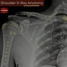 an x - ray image shows the chest and ribs with words written all over it